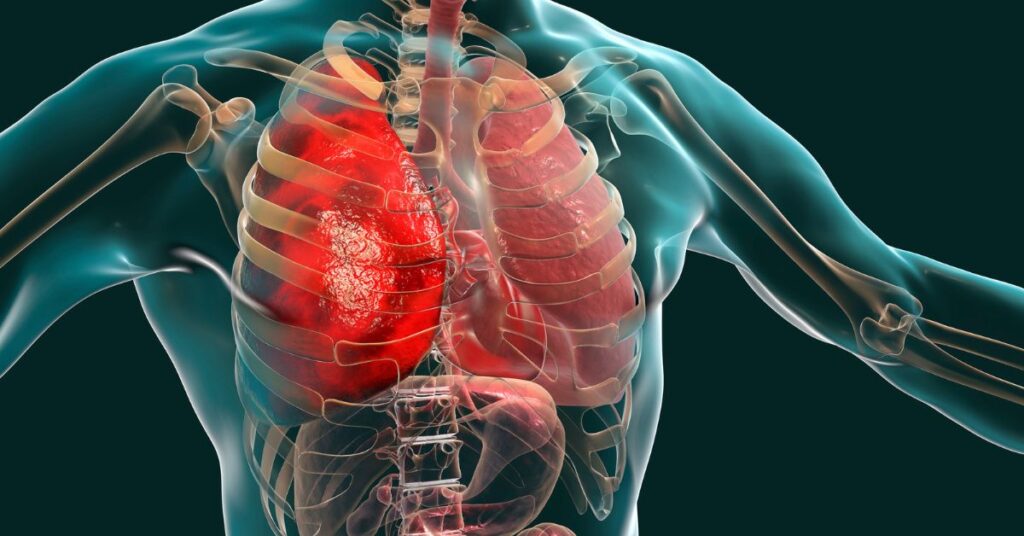 Water in Lungs - Causes, Symptoms, Treatment and Prevention